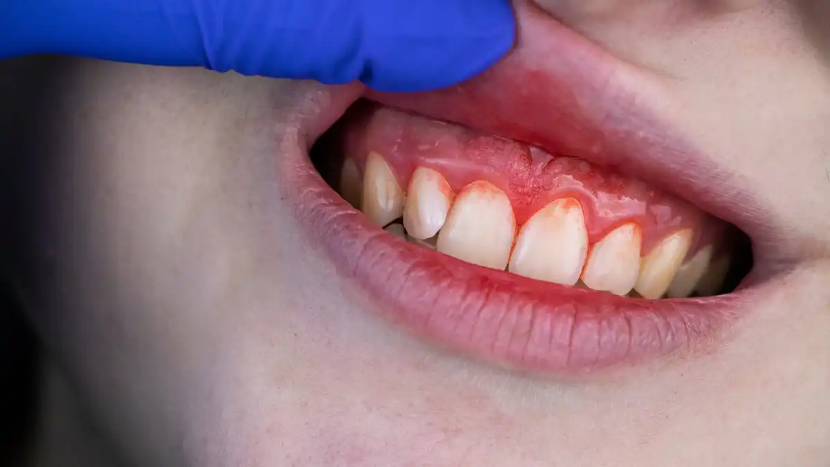 Bleeding Teeth and Gums featured