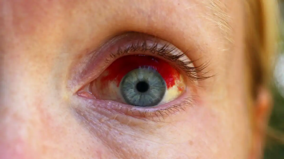 Broken Blood Vessel In Your Eye