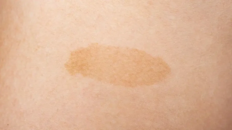 birthmark in buttock